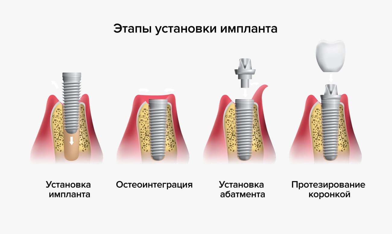 Как ставят импланты зубов по этапам фото Импланты зубов - рейтинг производителей, зачем нужны, фото