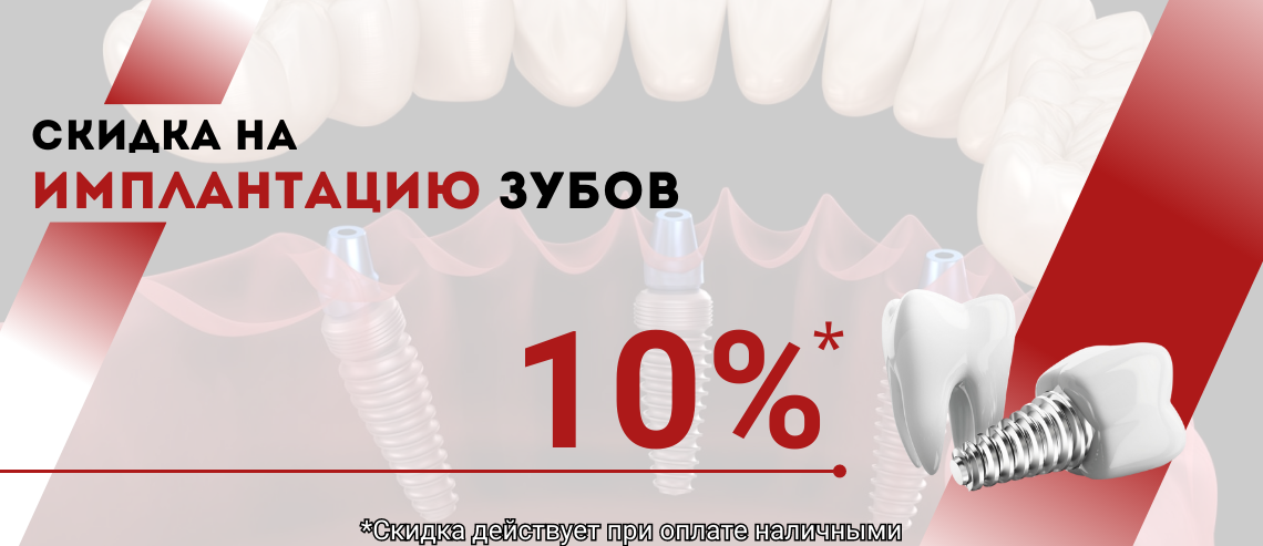 СКИДКА 10% НА ИМПЛАНТАЦИЮ