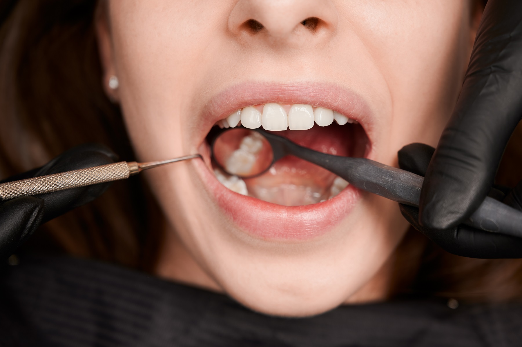 Стадии лечения зубов